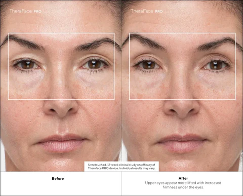 theraface pro before and after lifting results